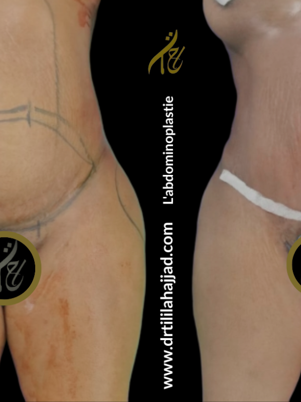 L'abdominoplastie