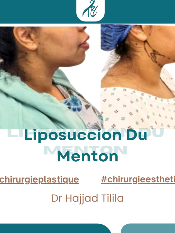 Liposuccion-Du -Menton