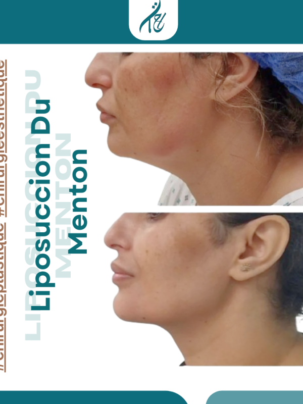 Liposuccion menton RABAT hay riad dr hajjad