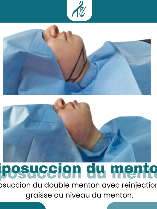 Liposuccion menton RABAT