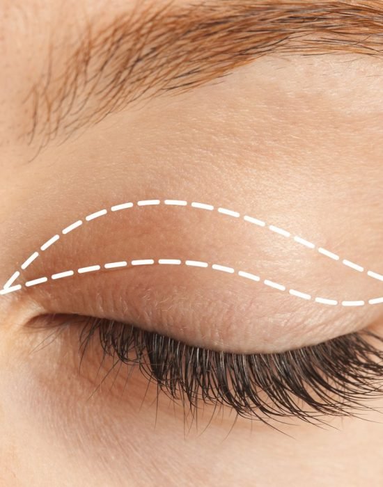 original_blepharoplasty-UPPER-EYE original_blepharoplasty-UPPER-EYE